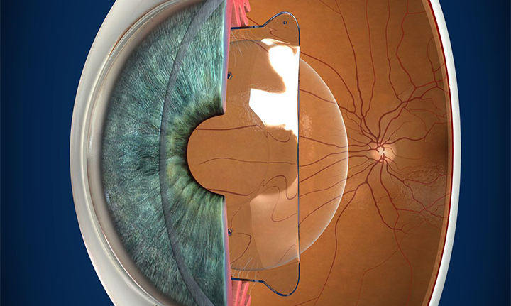 В 3Z имплантировали факичные ИОЛ пациентке с близорукостью -18 диоптрий