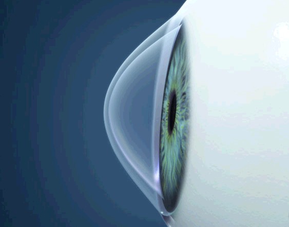 В офтальмологических клиниках 3Z эффективно лечат кератоконус