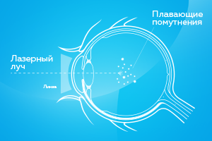 Теперь в клинике 3Z можно избавиться от помутнений в стекловидном теле 