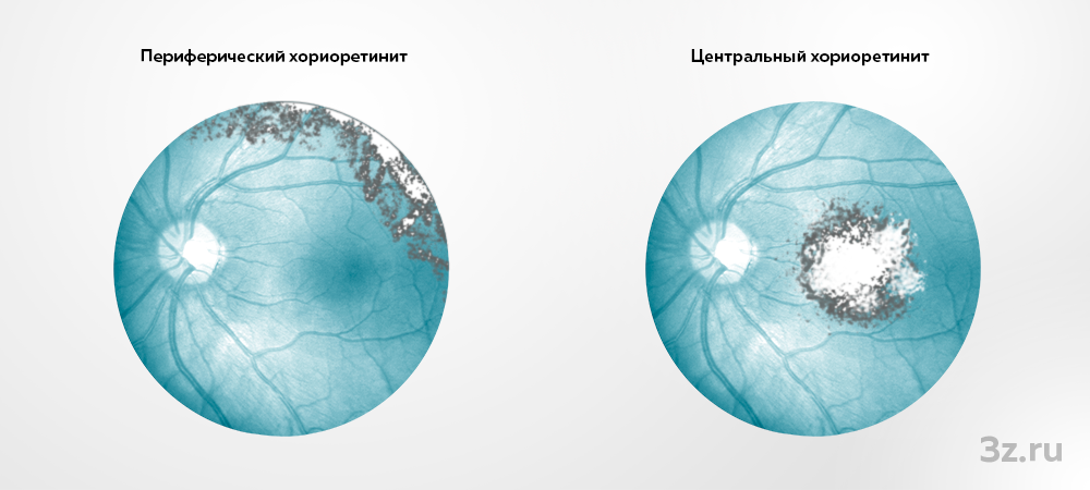 Хориоретинит — 3Z
