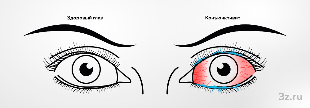 Конъюнктивит — 3Z