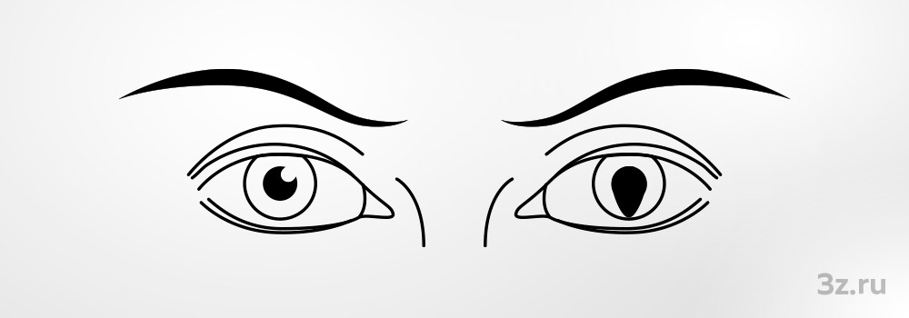 Колобома — 3Z