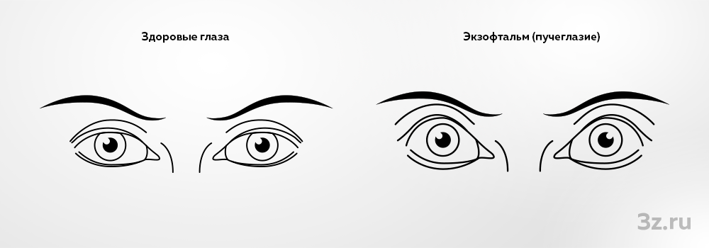 Экзофтальм — 3Z
