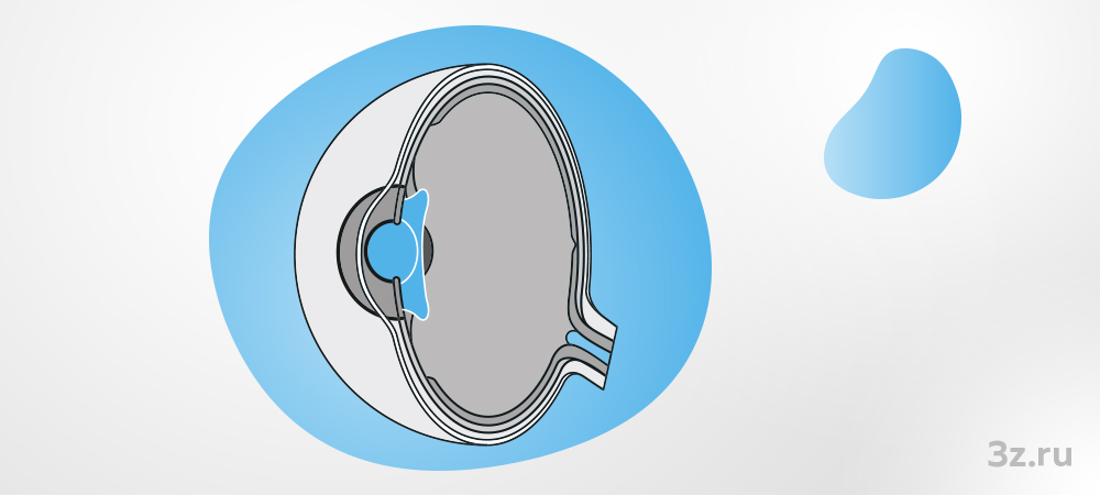 Памятка при имплантации ФИОЛ и пресбиФИОЛ &mdash; 3Z