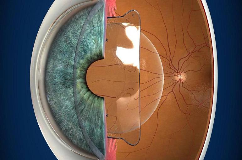 3Z — лидер по имплантации импортных факичных линз в России